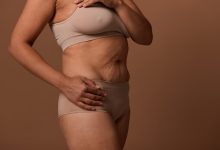 Abdominoplastia e cicatriz o que realmente esperar do resultado