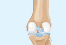 Lesão do LCP a lesão esquecida que pode deixar seu joelho instável