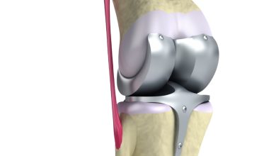 Prótese total de joelho quando esse tratamento é indicado