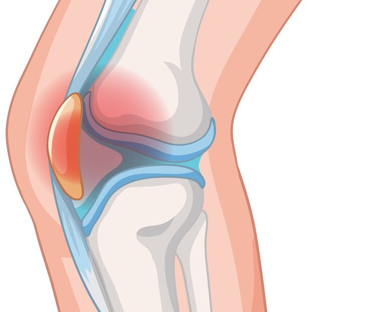 Dor na frente do joelho Pode ser condropatia patelar