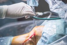 Sutura do menisco quando ela é indicada